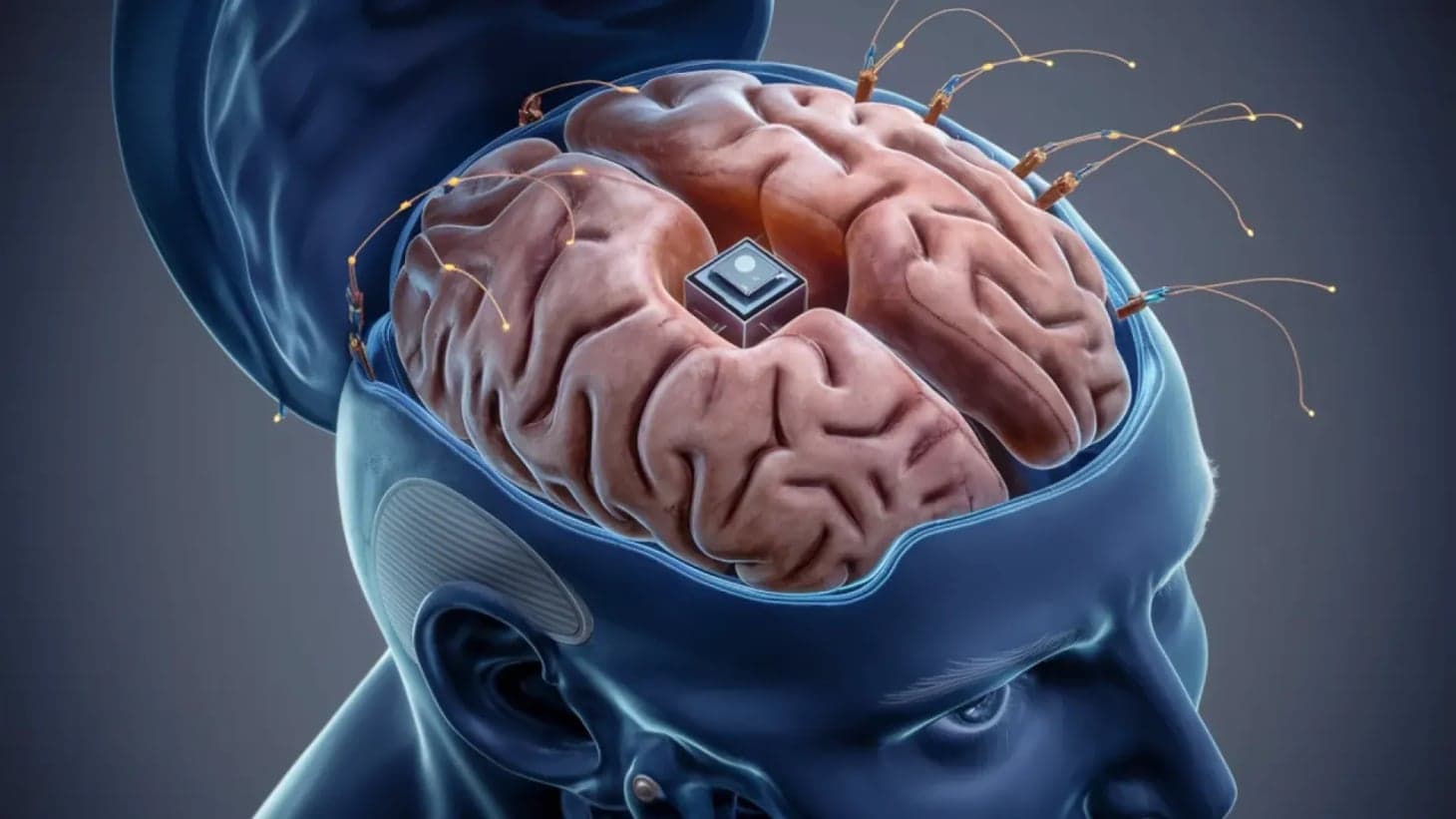 3D illustration of an open human head revealing a brain with a central microchip and multiple neural wires.